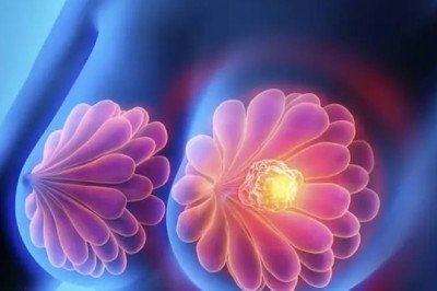 La probabilidad de sobrevivir al cáncer de mama en América Latina es de 89% si se detecta a tiempo