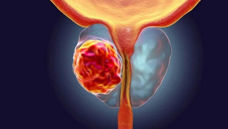 El cáncer de próstata tratado con crioablación beneficia a los hombres al no afectar las funciones sexuales y de incontinencia
