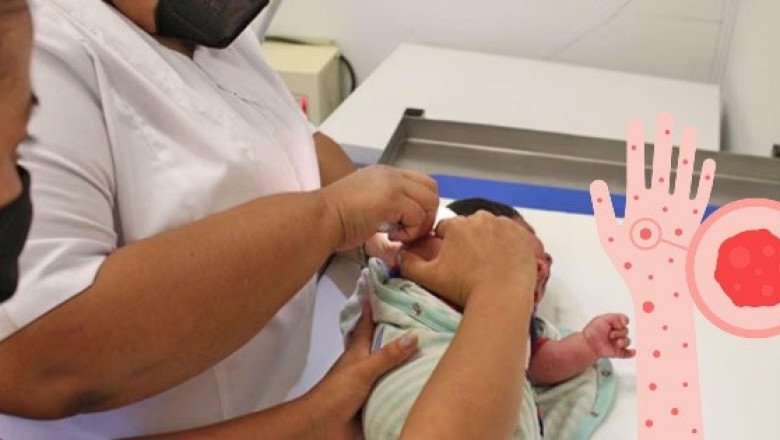 Confirman tres primeros casos de sarampión en este otro estado de México
