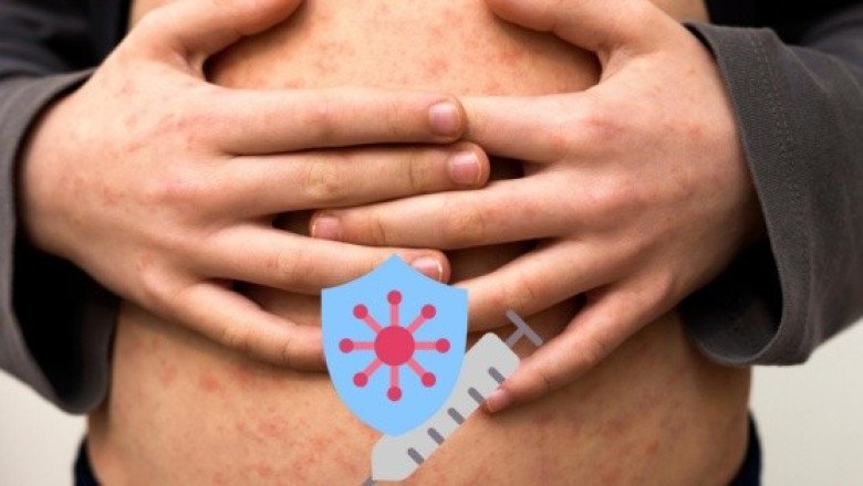 Sarampión: Síntomas y cómo se contagia la enfermedad