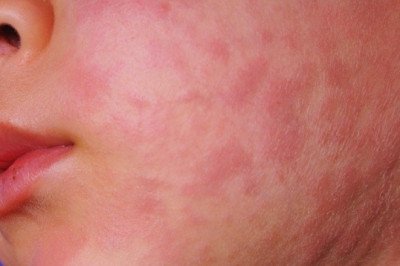 Hidalgo implementa medidas por sarampión en tres municipios