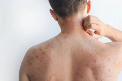 ¿Qué hacer para reducir los síntomas de sarampión?