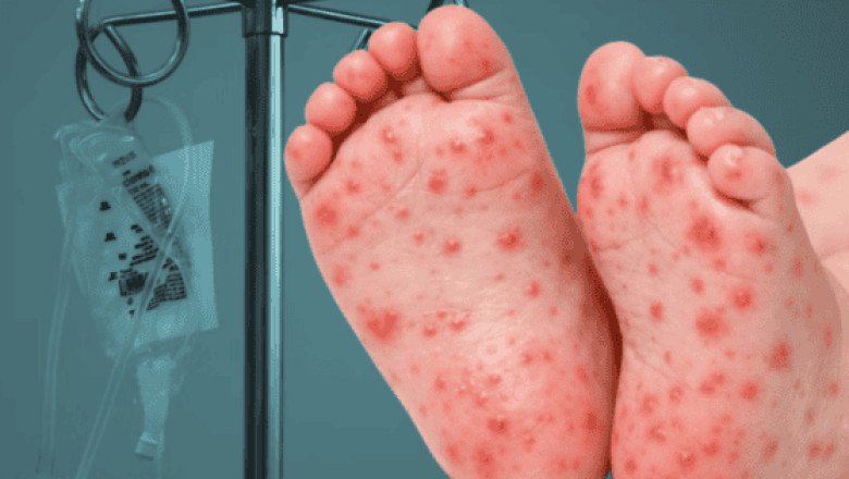 Registran primera muerte por sarampión en Guerrero